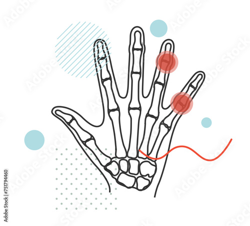 Inflamation - Finger Joint Pain as Stock Illustration