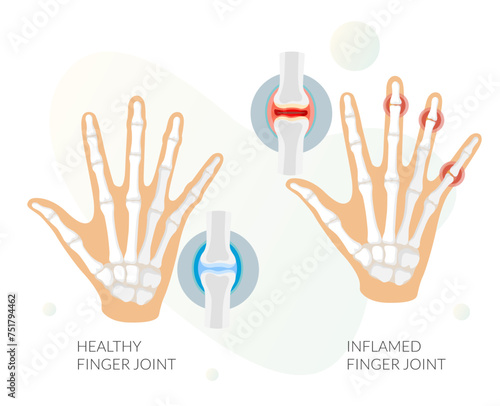 Inflamation - Finger Joint Pain as Stock Illustration