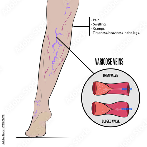 Varicose veins, swollen and twisted veins just under the skin.
