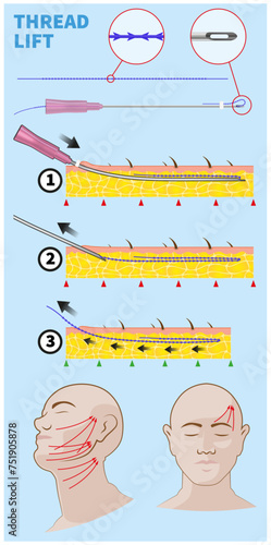 Facelift with ( PDO ) thread lifting technique and equipment illustration