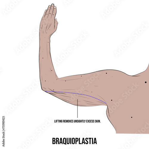 Vector brachioplasty or arm lift.
