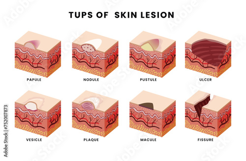 Types of skin lesion set collection for education poster, acne skin layers dermatology,skin disorder with Papules,Nodules, Pustules, Peptic Ulcer, Vesicles, Plaques
,Macules, Fissure. Isometric style 