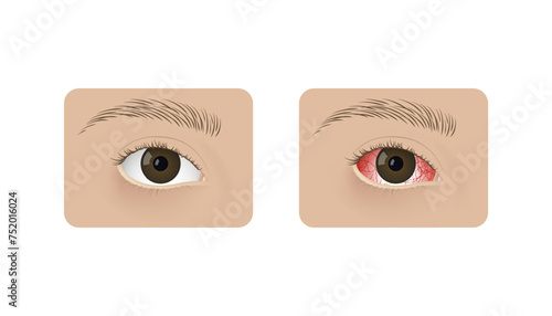 Realistic human healthy eye and with conjunctivitis vector illustration design.