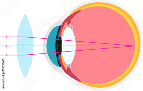 longsighted academic diagram structure anatomy photo