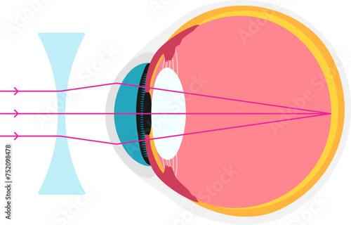 shortsighted academic diagram structure anatomy
