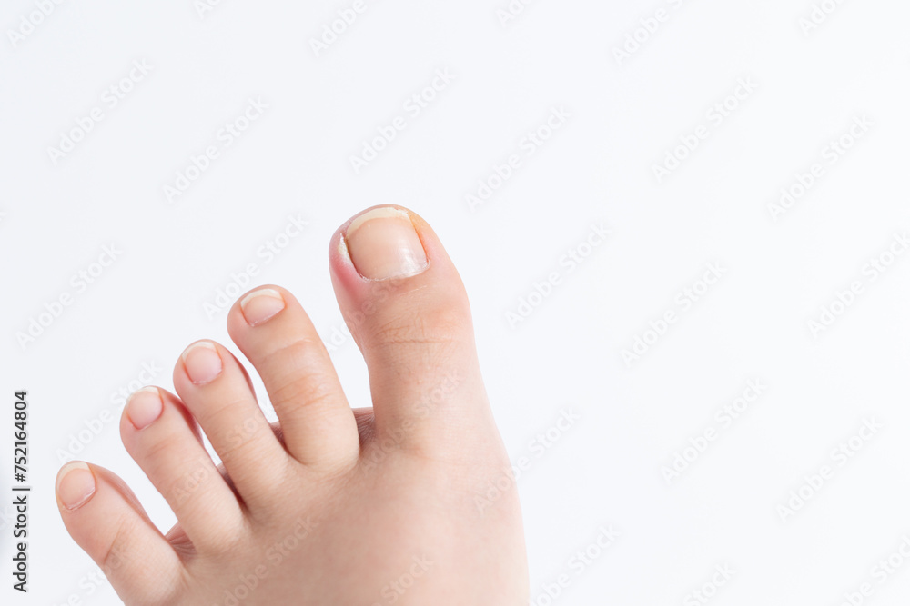 ingrown toenail on a child's foot, medical issue, discomfort. ingrown toenail on a child's foot, medical issue, discomfort.