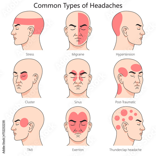 Human headache type structure diagram hand drawn schematic vector illustration. Medical science educational illustration