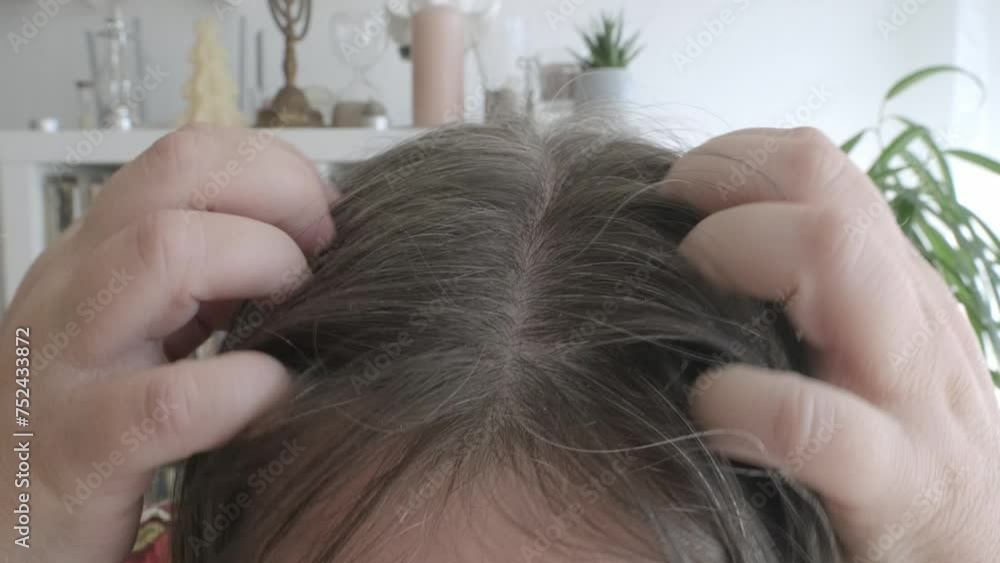 woman scratching head due to dandruff, showing visible flakes on shoulders, discomfort and social impact of condition, need for treatment, flaking and itching woman scratching head due to dandruff, showing visible flakes on shoulders, discomfort and social impact of condition, need for treatment, flaking and itching