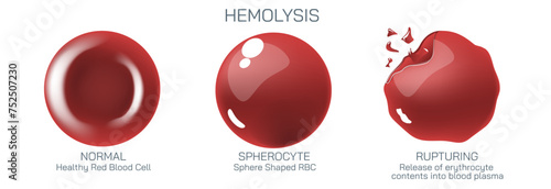 The rupture or destruction of red blood cells is called Hemolysis vector illustration. A type of blood cell that is made in the bone marrow and found in the blood.