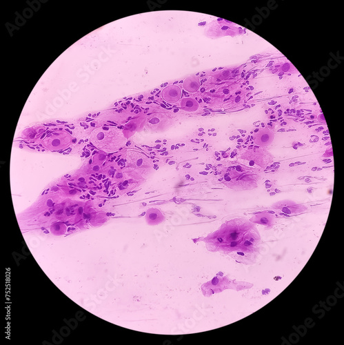 Cervical cancer cells. Atypical squamous cells of undetermined significance(ASCUS), Cancer of cervix, Pap's smear, pap's. photo