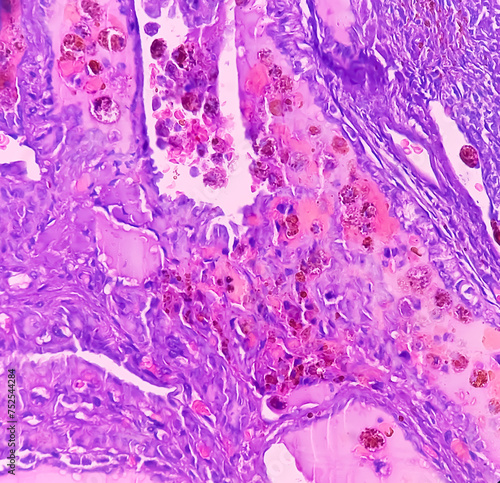 Thyroid cancer, Papillary thyroid microcarcinoma with nodular colloid goitre. Atypical thyroid follicular cells show nuclear clearing. Extensive fibrosis. photo