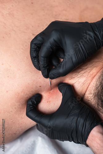 Akupunktura na plecach, wbijanie igieł © Marcin