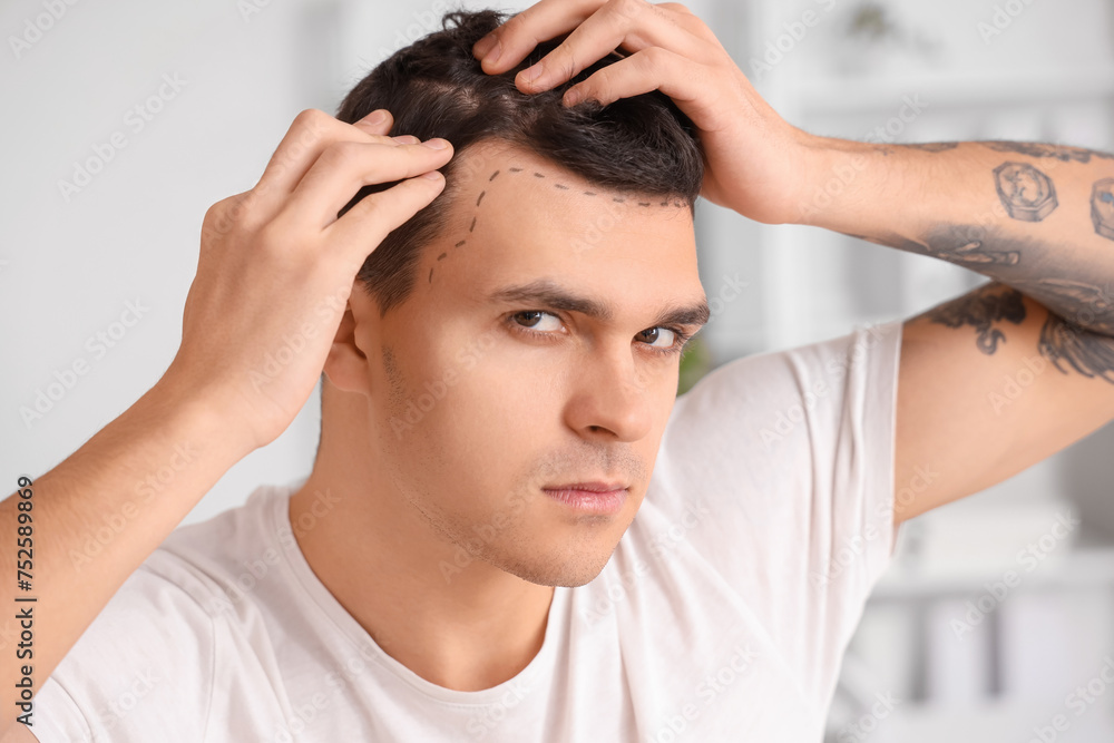 Young man with hair loss problem and marked forehead in clinic, closeup Young man with hair loss problem and marked forehead in clinic, closeup