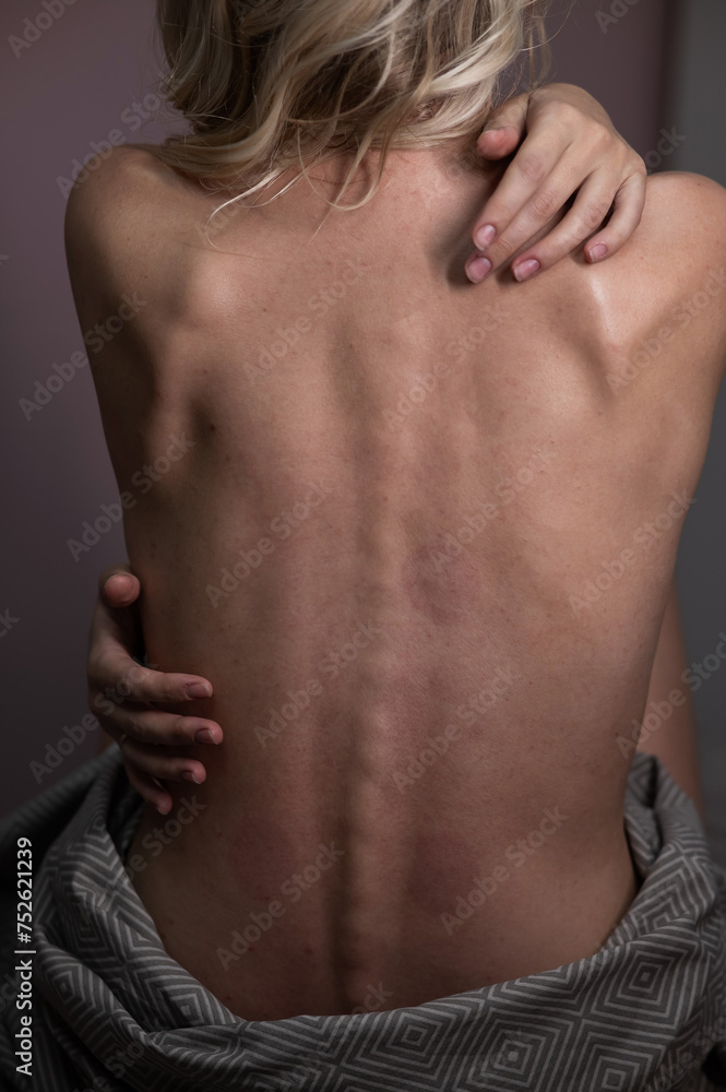 Caucasian woman after back massage with vacuum cups. Vertical photo.