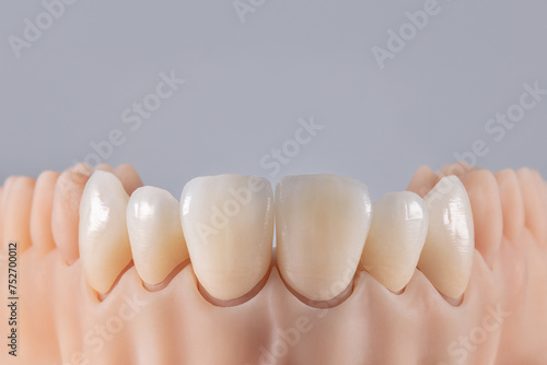 Six ceramic crowns on silicone gums. Dental model of teeth front view.