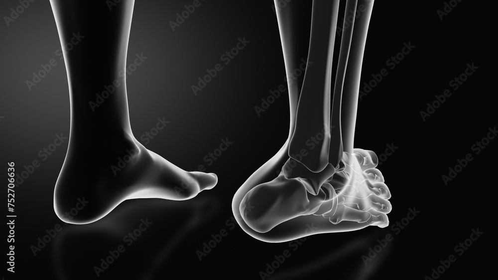 Ankle injury with dislocation and sprains - obrazy, fototapety, plakaty 