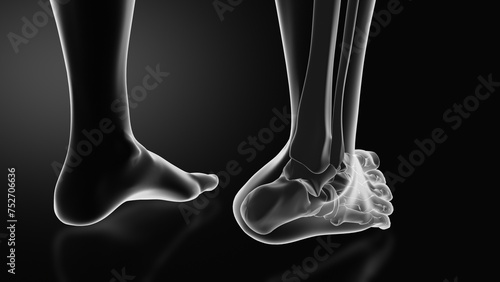 Ankle injury with dislocation and sprains photo