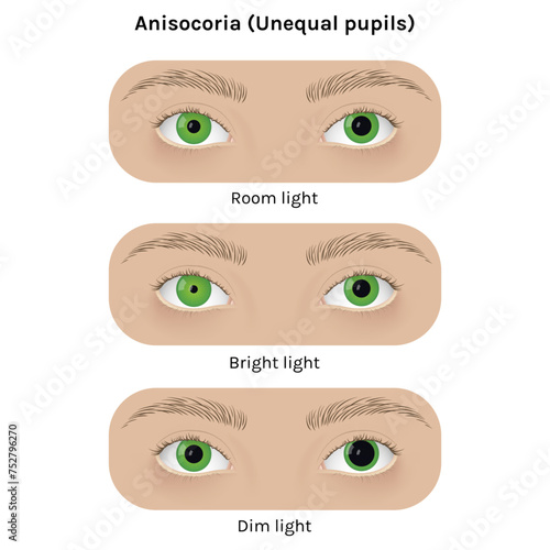 Realistic human eyes with anisocoria vector illustration design.
