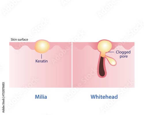 Comparison of Milia and Whitehead vector illustration isolated on white background. Milia, small white bump, trapped keratin. Whitehead, closed comedone, clogged pore. Skin care and beauty concept. 