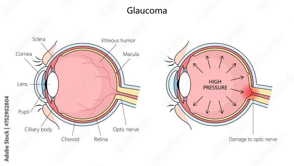 Set Of 2 Framed Medical Posters - The Eye & Understanding Glaucoma, 22x28 Inch, Educational Wall Art For Classroom Or Office