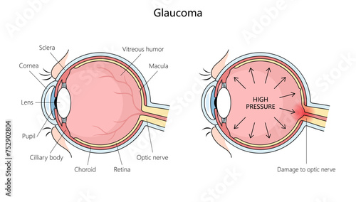 anatomy of a human eye with glaucoma, highlighting increased pressure and optic nerve damage structure diagram hand drawn schematic vector illustration. Medical science educational illustration