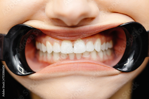 Fotografie Close up of woman cavity protected by retractor showing perfect teeth