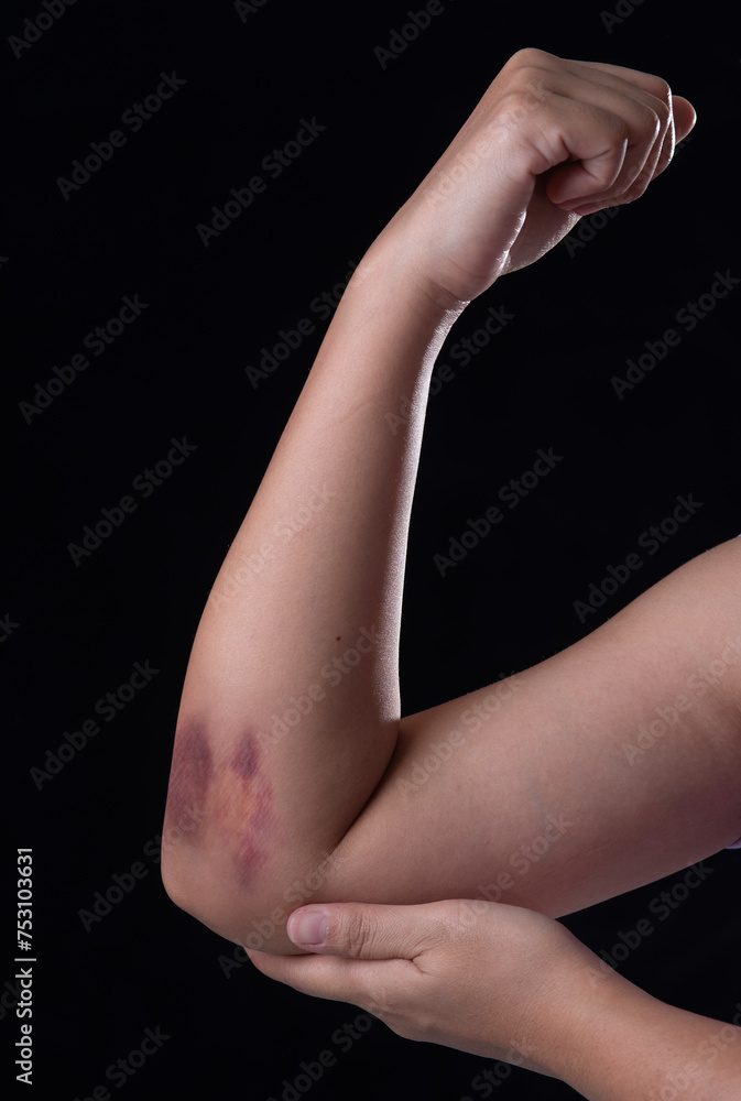 Naklejka premium Bruises from blood on woman arm. Injection bruises.