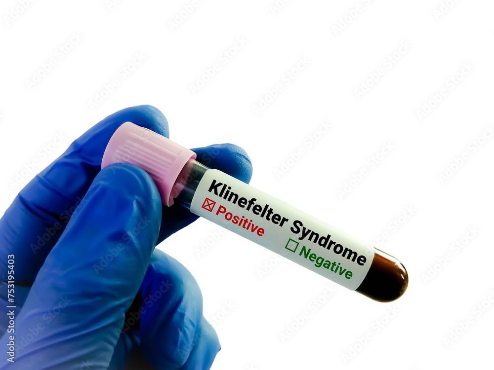 Obraz premium Klinefelter syndrome, a condition where the boys and men are born with an extra X chromosome. Klinefelter's, KS or XXY