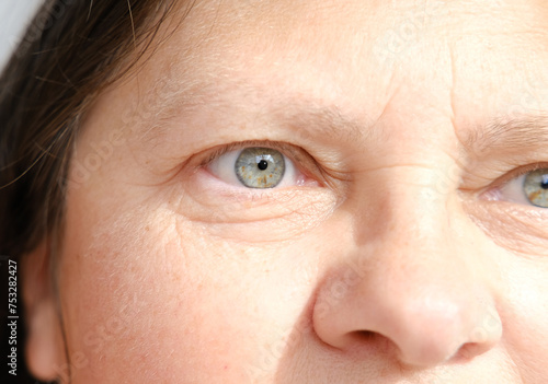 close up part face mature woman 55 years old, upper half of face, deep wrinkles around eyes, sagging cheeks, aesthetic injection cosmetology, correction surgery, antiaging procedures