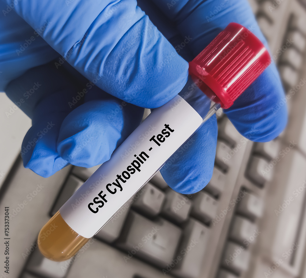 Cytospin test. Cerebrospinal fluid (CSF) cytology testing. It was performed using