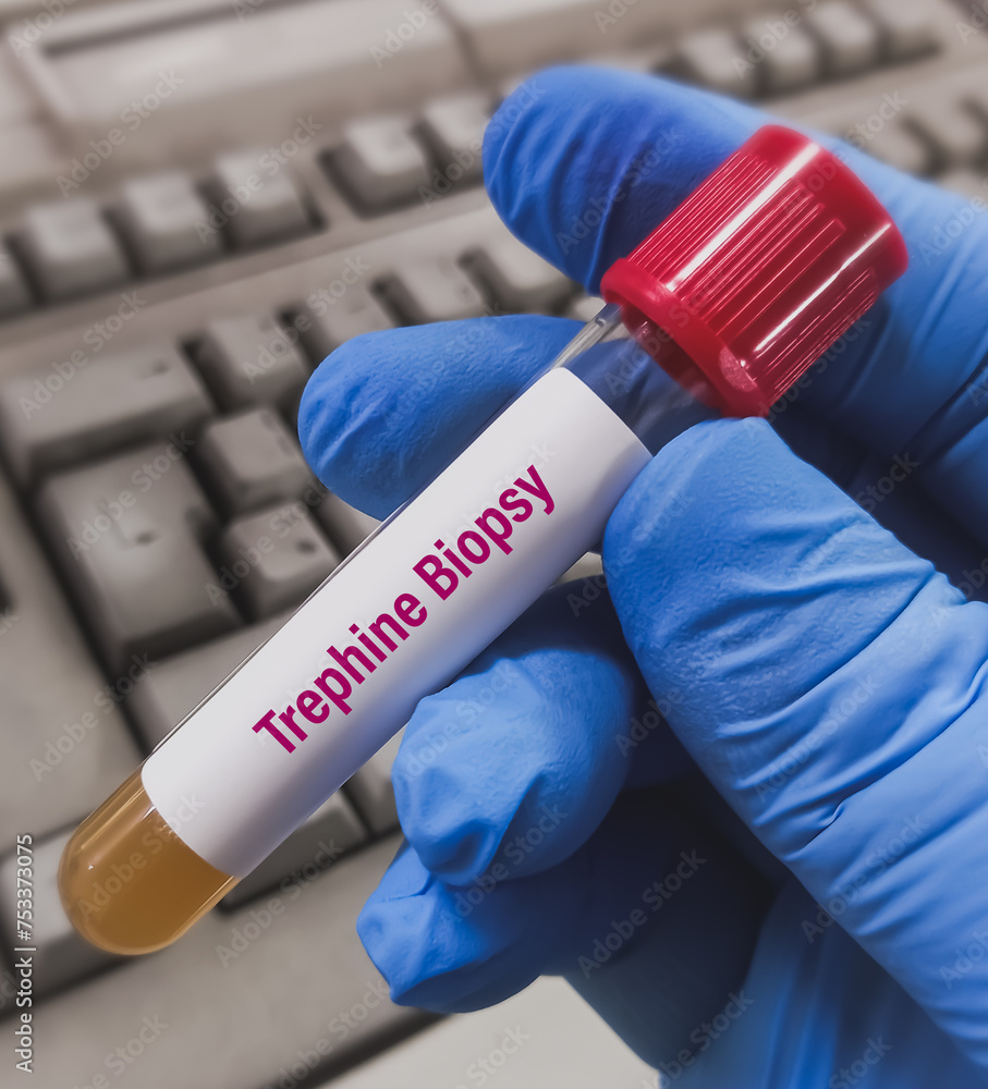 Bone marrow sample for Trephine biopsy test, to diagnosis Non-Hodgkin ...