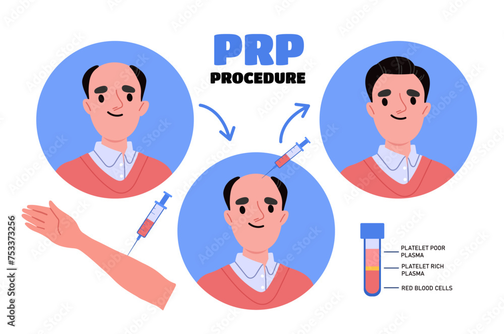 Prp procedure concept. Medical infographics and educational materials. Fght against hair loss. Health care, diagnosis and treatment. Cartoon flat vector illustration isolated on white background