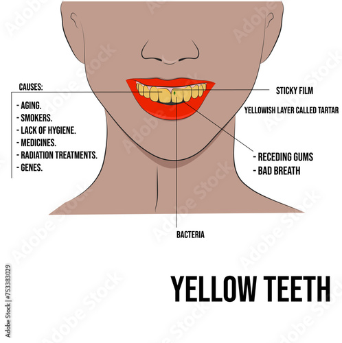 Yellow teeth, lack of oral hygiene and accumulation of bacterial plaque.