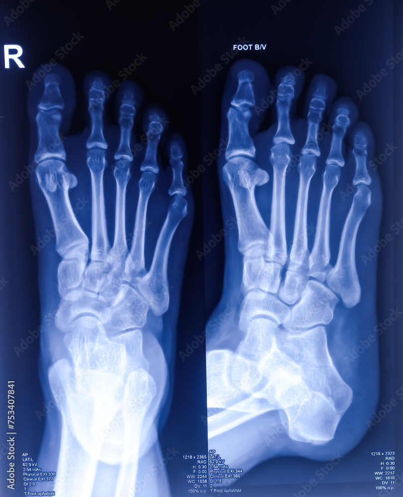 X-ray of foot both view. foot xray. ankle joint. X-ray of foot both view. foot xray. ankle joint.