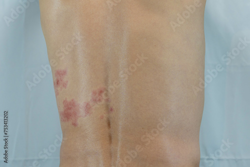 胴体の左側に帯状疱疹を発症した男性の画像 
