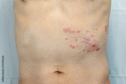 胴体の左側に帯状疱疹を発症した男性の画像
 photo