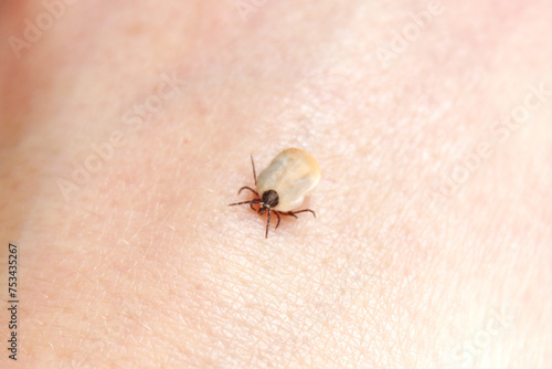 Engorged black legged deer tick crawling on a human skin close up