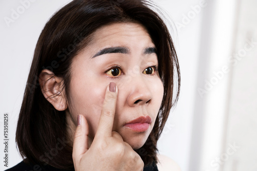 Asian woman checking her yellow eyes concept of Jaundice Eyes or Viral Hepatitis