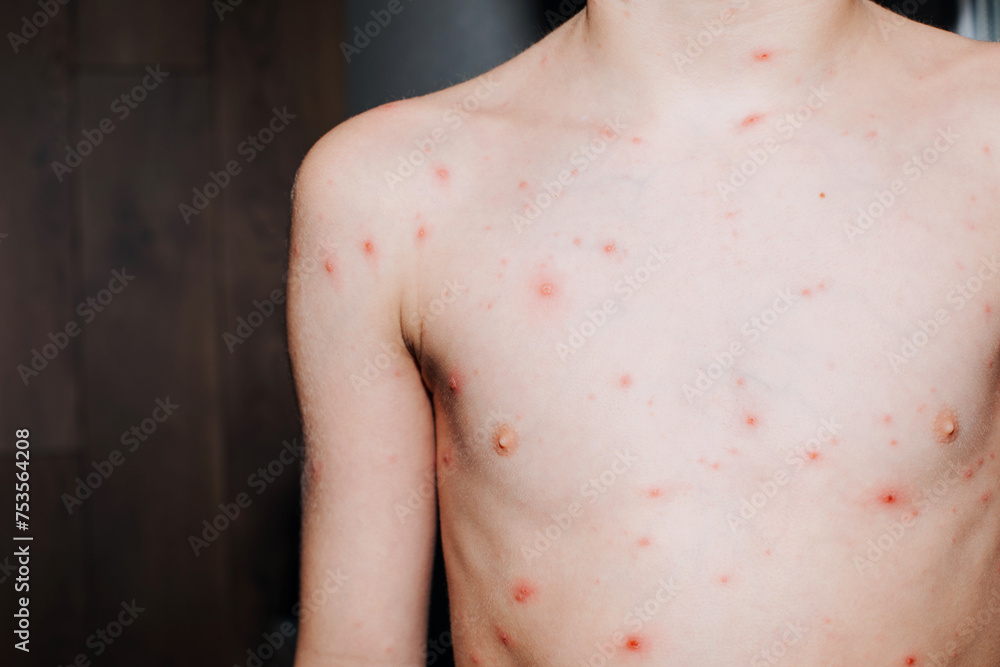 Viral diseases with a rash on the body. Chickenpox on the child's body. Treatment of chickenpox. Front view Viral diseases with a rash on the body. Chickenpox on the child's body. Treatment of chickenpox. Front view