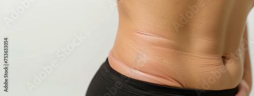 Sagging abdominal skin after weight loss. Close-up of abdomen with Fat folds, banner for plastic surgery clinic, skin tightening. photo