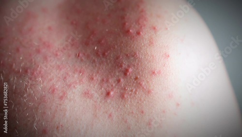 Close-up shot of skin rashes and pimples on human shoulder, red itchy spots being an allergy reaction on food, medicine, stress, imbalanced hormones, cancer disease, some chemicals or unhygienic