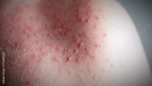 Close-up shot of skin rashes and pimples on human shoulder, red itchy spots being an allergy reaction on food, medicine, stress, imbalanced hormones, cancer disease, some chemicals or unhygienic photo