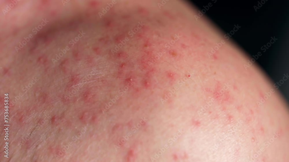 Person hand massaging skin rashes with medical ointment, red itchy