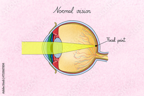 Human eye with myopia. Illustration