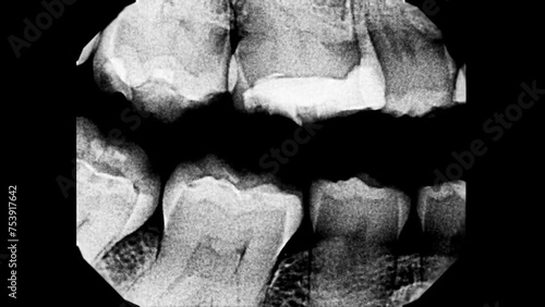 Stop motion video of human teeth X-Ray image. Teeth fillings scan and dental nerve removal. Examination and prevention diagnostic of the patient's mouth in dental clinic. photo
