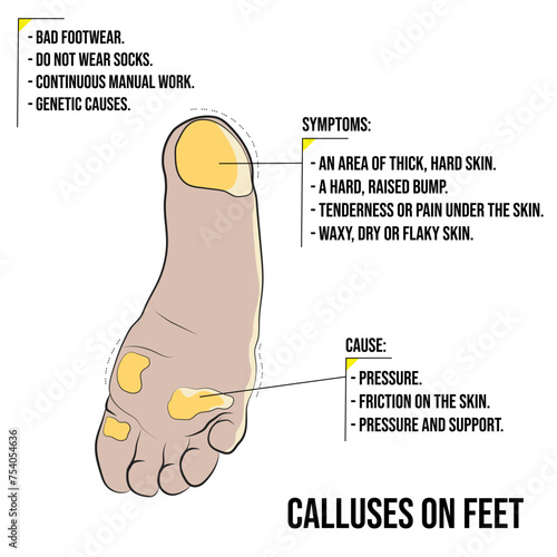 Calluses on the feet, thick skin on one side of the foot.