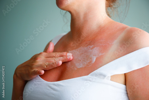 Woman with sunburned skin. Burn.