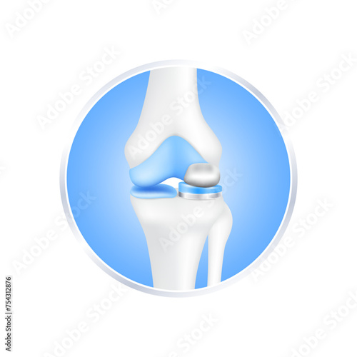 label aluminum. Knee replacement surgery partial implant for treatment relieve arthritis, after joint damaged. Leg bone cartilage. Isolated on white background for product design. Realistic 3d vector.