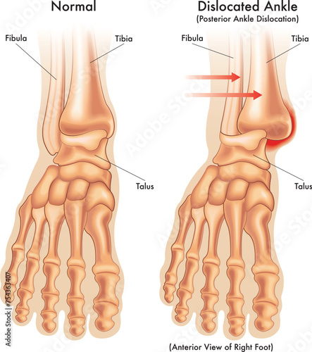 Medical illustration comparing a normal ankle, with a dislocated ankle, with annotations.