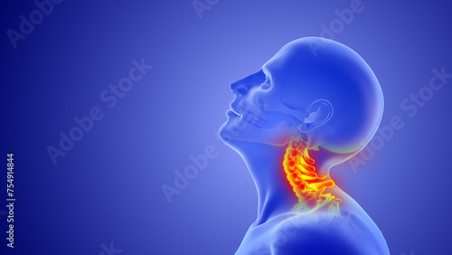 Whiplash mechanism in cervical spine or neck injuries photo